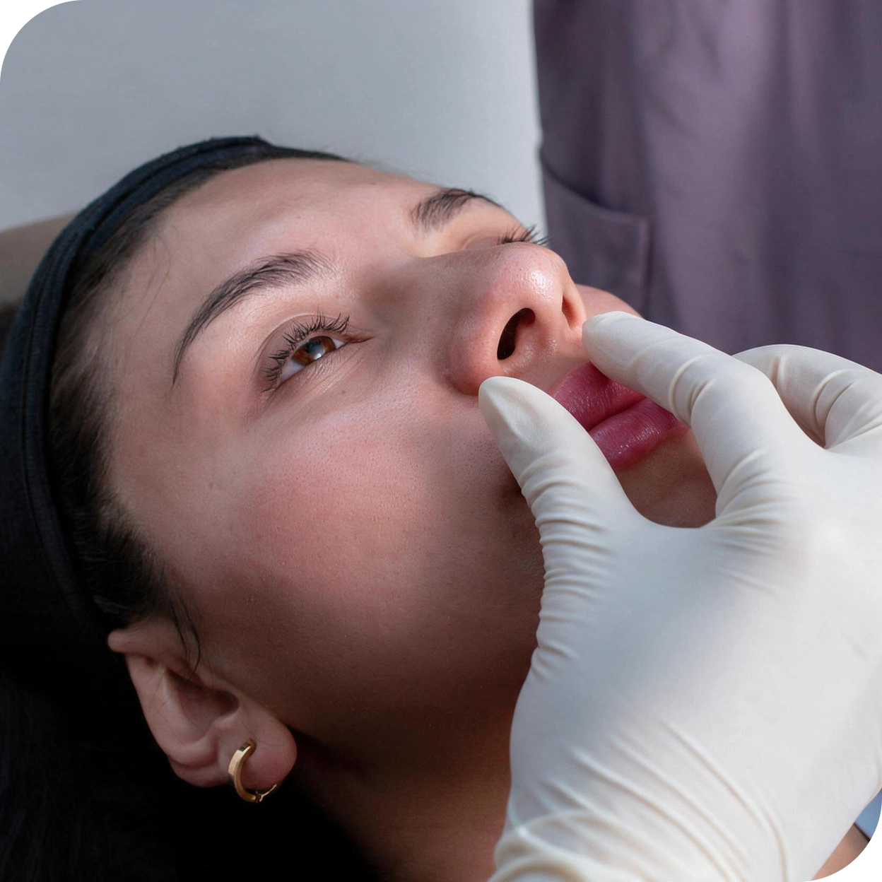 Behandlung der Oberlippe beim Lip Flip mit Botulinumtoxin