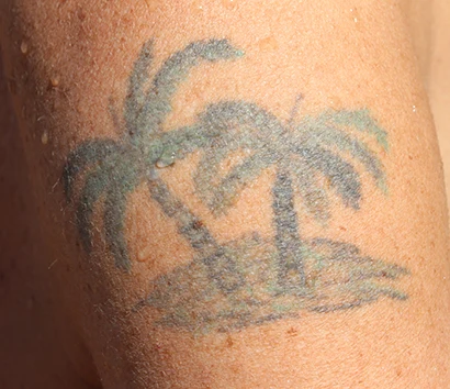 tattooentfernung ausgebleichtes tattoo zuerich