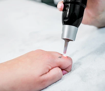 tattooentfernung hand pico laser