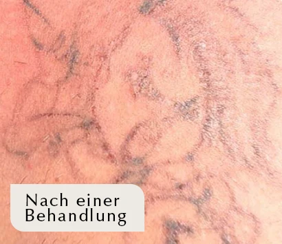 Tattoo nach der Laserbehandlung – individuelles Behandlungsbeispiel