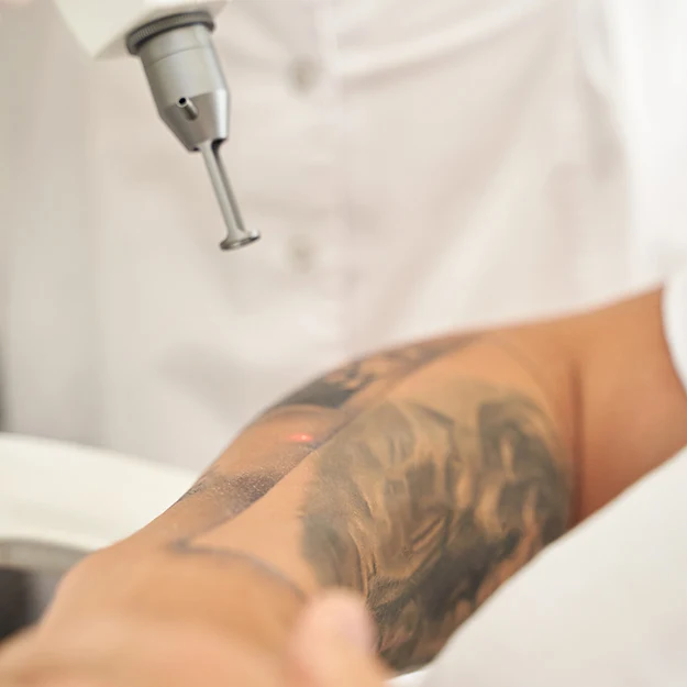 tattooentfernung pico laser ablauf