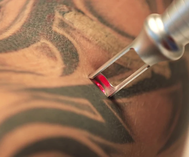 tattooentfernung pico laser individuell abgestimmt farbe pigmente