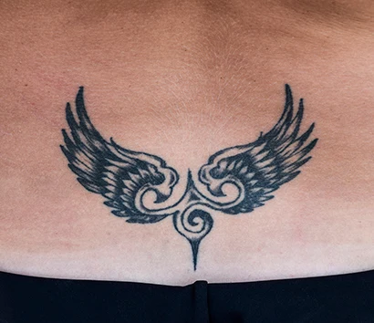 tattooentfernung zuerich pico laser