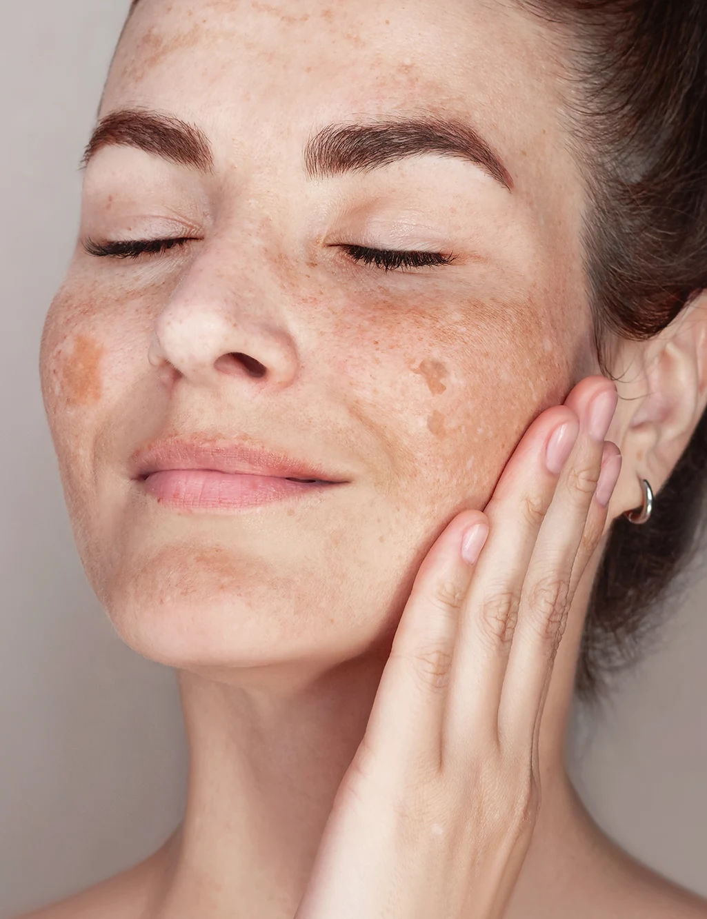 weitere beitraege pigmentflecken pico laser angepasst